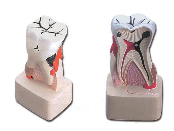 MODELLO PATOLOGIA DENTALE